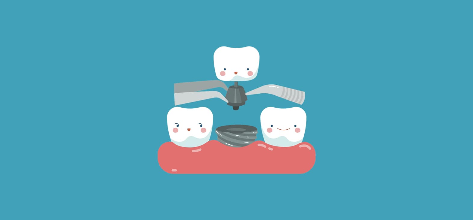 Dental Implants